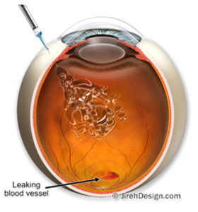 Retinopatia Diab Tica Cl Nica Roisman