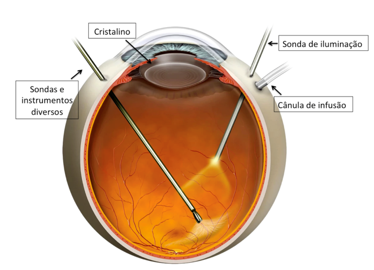 Cirurgia de Retina A Vitrectomia Clínica Roisman