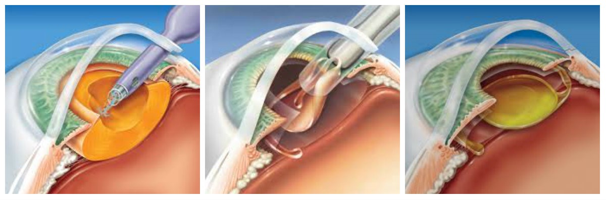 Замена хрусталика глаза как проходит операция. Факоэмульсификация с имплантацией ИОЛ. Имплантация интраокулярной линзы. Катаракта ФЭК этапы операции.
