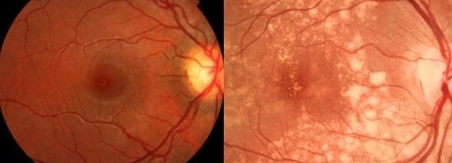 À esquerda uma retina normal e à direita observa-se a formação de drusas, que são estes focos amarelados na região da mácula.