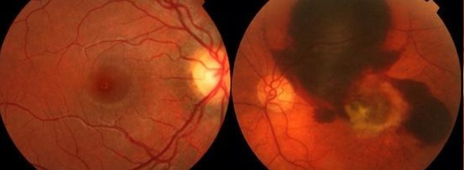 À esquerda uma retina normal e à direita observa-se DMRI na forma seca associado a atrofia (área mais clara) da parte central da mácula.