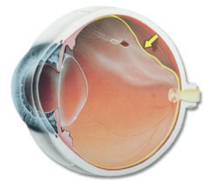 Descolamento de retina: sintomas e tratamento