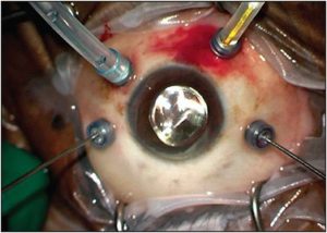 Cirurgia e Tratamento para Descolamento de Retina - COHR