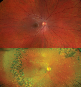 panfotocoagulação retiniana